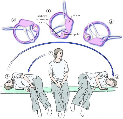 Epley maneuver at home video The Epley maneuver is used to move the canaliths out of the canals so they stop causing symptoms